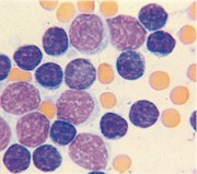 Leucemia